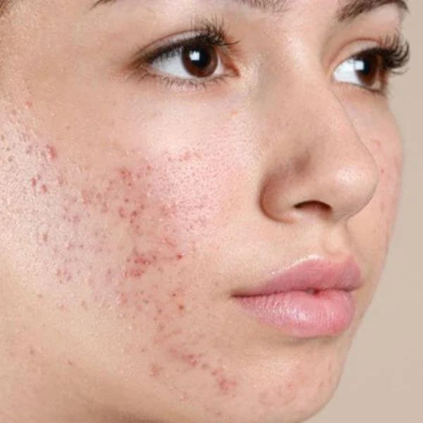 Advanced Fractional LASERS (Skin & Scars)