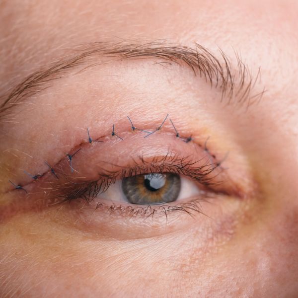 Blepharoplasty (Eyelid Surgery)