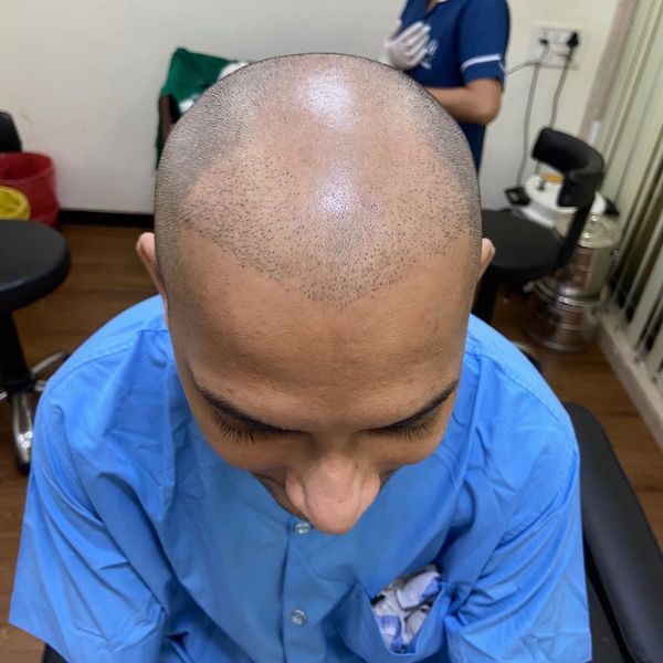 Hair Transplant (FUE / FUT)