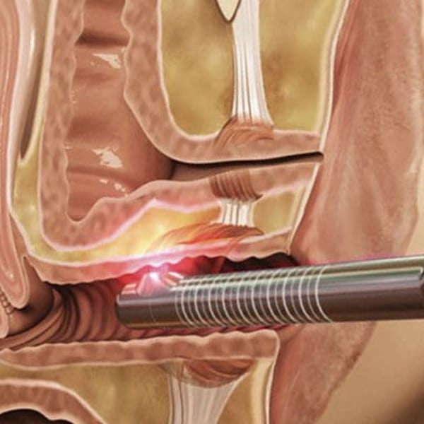 LASER Feminine Rejuvenation