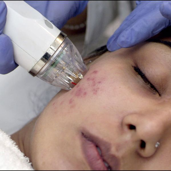 Microneedling Radiofrequency
