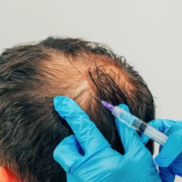 PRP Therapy for Hair