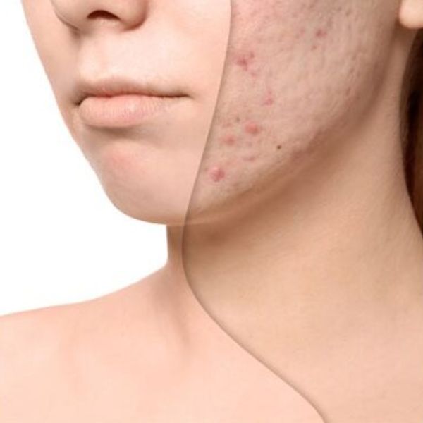 Scar Reduction