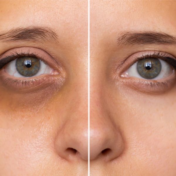 Under Eye Dark Circles Correction