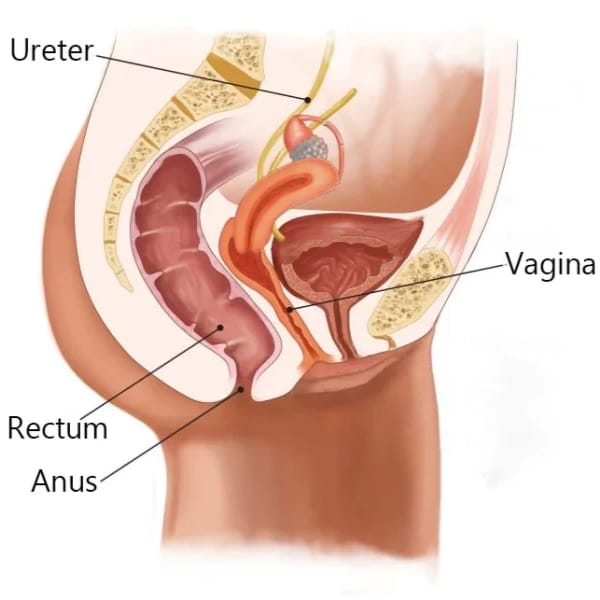 Vaginoplasty