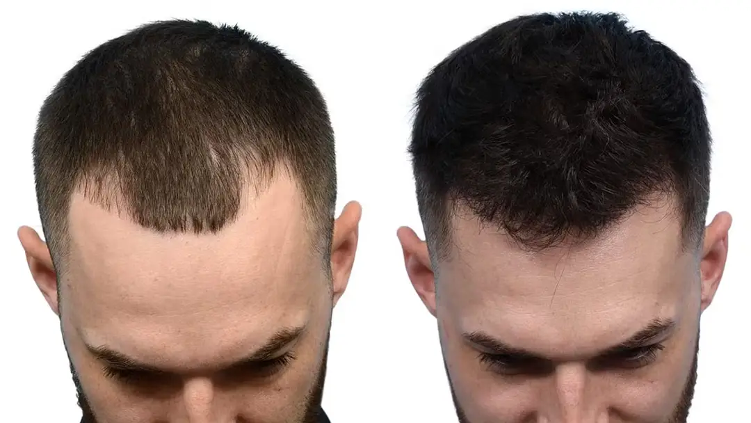Hair Transplant with Natural Results